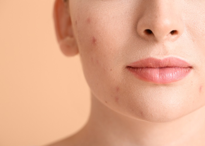 young woman with acne